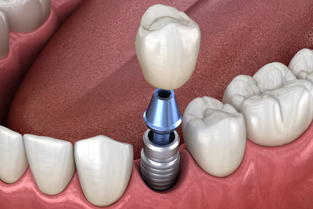 Dental Implants • Temple, TX • Verbena Family Dentistry